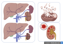 Examples of Signs and Symptoms of Kidney Ischemia. On the left shows the difference in the size of the kidneys resulting from Kidney Ischemia. Kidney Ischemia may result in a shrinkage of the kidney to about 2cm or more. The top right shows the disruption of the mitochondria due to dysfunctions, This leads to a release of proapoptotic proteins such as cytochrome c and results in cell death. The lower right shows inflammation of the glomeruli of the kidneys. This schematic diagram was drawn using BioRender.com Examples of Signs and Symptoms of Kidney Ischemia.png
