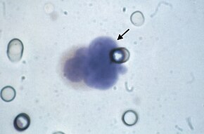 Abbildung 1, Bild einer zirkulierenden Tumorzelle, Pfeil, diagnostiziert durch den ISET-Test..jpg