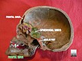 Frontal sinus