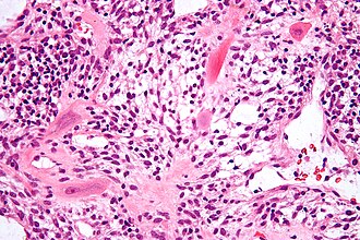 Micrograph showing intermediate trophoblasts. H&E stain. Intermediate trophoblast - high mag.jpg