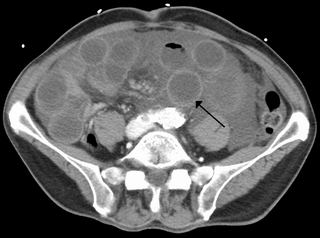 Intestinal ischemia Restriction of blood flow to the small intestine resulting in injury