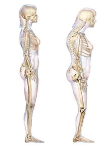 https://upload.wikimedia.org/wikipedia/commons/thumb/d/dc/Kyphosis_Degenerative.png/220px-Kyphosis_Degenerative.png