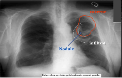 Primo infection test negatif