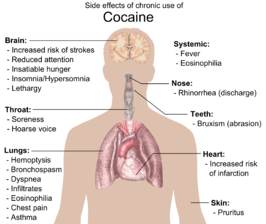 Intoxicação por cocaína – Wikipédia, a enciclopédia livre