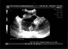 Ultrasonography of the uterine pregnancy of a roe deer in Bulgaria Ultrasonography of pregnant European roe deer (Capreolus Capreolus).jpg