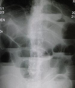 Upright تصوير بالأشعة السينية للبطن demonstrating a small bowel obstruction. Note multiple air fluid levels.