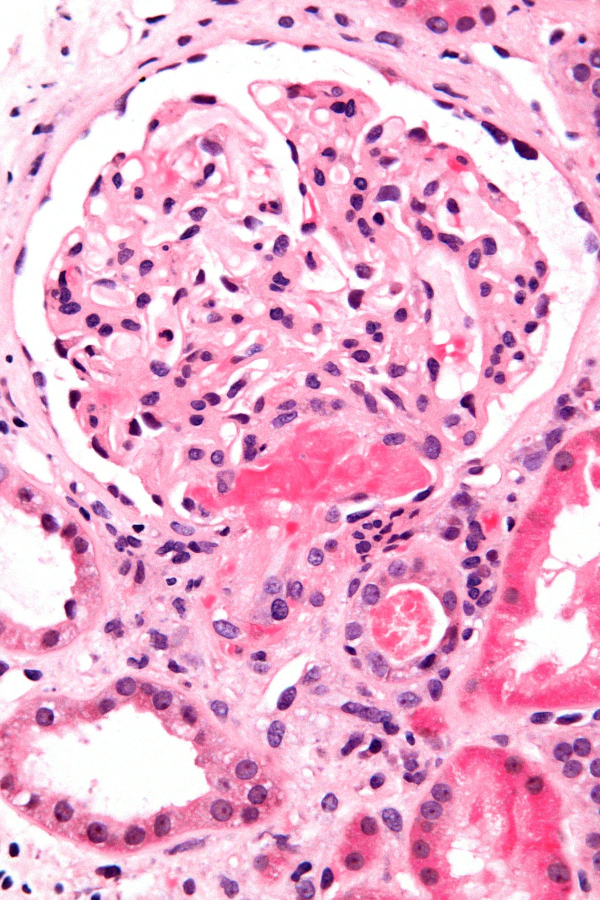 thrombotic thrombocytopenic purpura histology