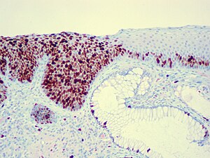 Carcinoma In Situ: Beispiele, Therapie, Histologie und chromosomale Veränderungen