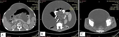 Fig. 16. A 24 year old male patient with fibrotic type of tubercular peritonitis.[1] A. Marked ascites with centrally displaced bowel loops, mimicking peritoneal carcinomatosis. Splenic microabscesses (curved arrow) also noted. B. Peripherally enhancing central hypodense mesenteric lymph nodes (arrow). C. Smooth peritoneal thickening and enhancement.[1]