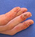 Advanced stage of dyshidrosis on the fingers