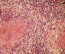 Epithelioid cells gather around the focus of necrosis, in direct contact with the necrotic masses, forming a kind of boundary zone. Epithelioid cells in caseating tuberculous granuloma.jpg