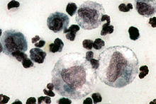 Cytology of FIP-induced fluid showing neutrophils, macrophages and lymphocytes FIPCytology2.jpg