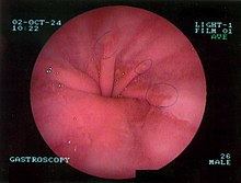 Occlusion intestinale symptomes