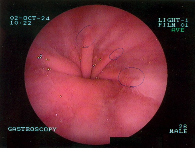 File:Hiatus-hernia.jpg