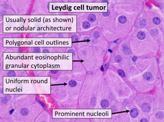 <span class="mw-page-title-main">Leydig cell tumour</span> Medical condition