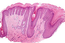 Lichen simplex chronicus - low mag.jpg
