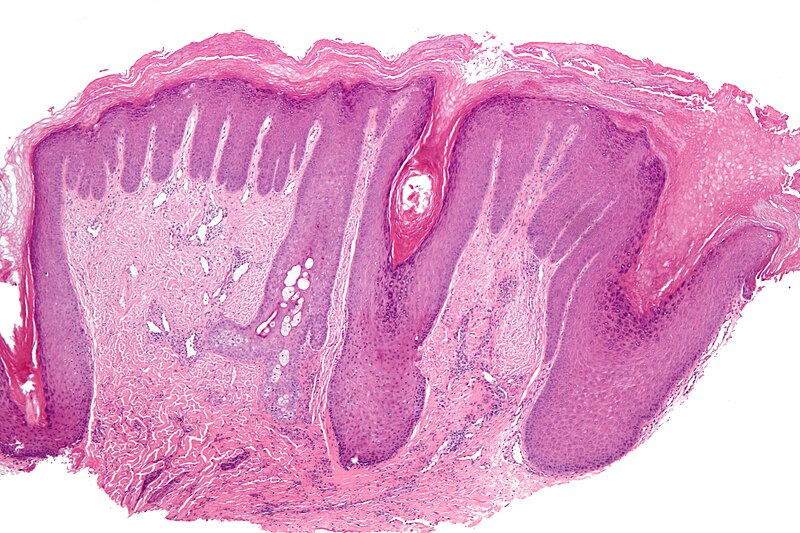 File:Lichen simplex chronicus - low mag.jpg