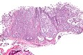 Myoepithelioma - low mag.jpg