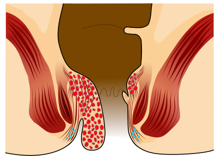 ไฟล์:Piles_Grade_3.svg