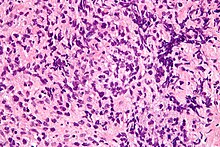 Micrograph of a primary mediastinal large B-cell lymphoma, a rare type of lymphoma that arises in the mediastinum. H&E stain. Primary mediastinal large B-cell lymphoma - very high mag.jpg