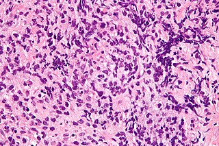 <span class="mw-page-title-main">Primary mediastinal B-cell lymphoma</span> Medical condition