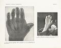 Hipoplasia y aplasia completa de las falanges medias de los dedos de la mano, resultando en braquidactilia generalizada.