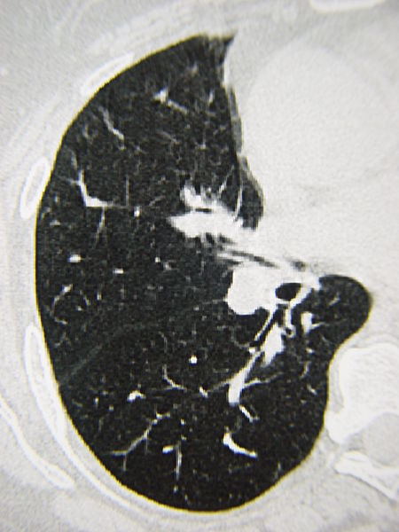 File:Systemic sclerosis case 10 pic 03.jpg