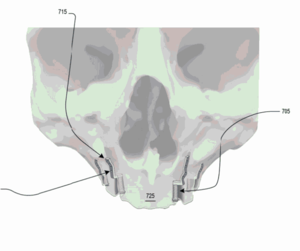 Dental post attached to custom bone plate contoured to fit vertical pillars Transalveolar dental implant - front view.png