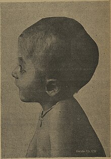 Symptoms of Carpenter syndrome in an 8-year-old boy, 1919 Acrocephalie 1.jpg