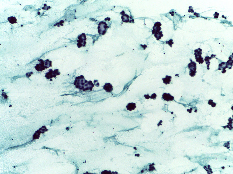 File:Adenocarcinoma fluid cytology smear.jpg