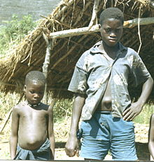 Children with umbilical hernias, Sierra Leone (West Africa), 1967.jpg