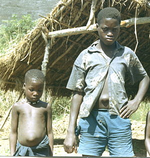 Діти з пупковими грижами, Сьєрра-Леоне (Західна Африка), 1967.