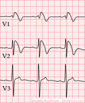 Thumbnail for File:De-Brugada (CardioNetworks ECGpedia).png