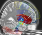 Reconstruction of DBS electrodes. Shown are the subthalamic nucleus (orange), red nucleus (green), the substantia nigra (yellow), the internal (cyan) and external pallidum (blue) and the striatum (red). A volume of tissue activated (VTA) is modeled around the electrodes. Structural fibertracts traversing through this volume are visualized with color-coded fibers and cortical regions that they terminate in are visualized with translucent colors.[1]