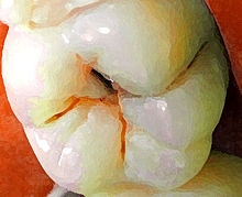 Molar viewed from top, with a cavity in the central pit, and a small amount of blood in nearby fissures.
