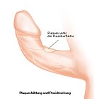 Curvature of the human penis due to Peyronie's disease