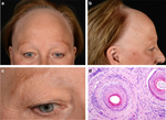 Thumbnail for Frontal fibrosing alopecia