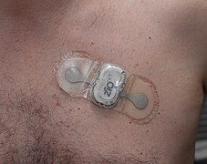 Zio XT patch, a more modern Holter monitor containing two leads that can continuously monitor for up to 14 days