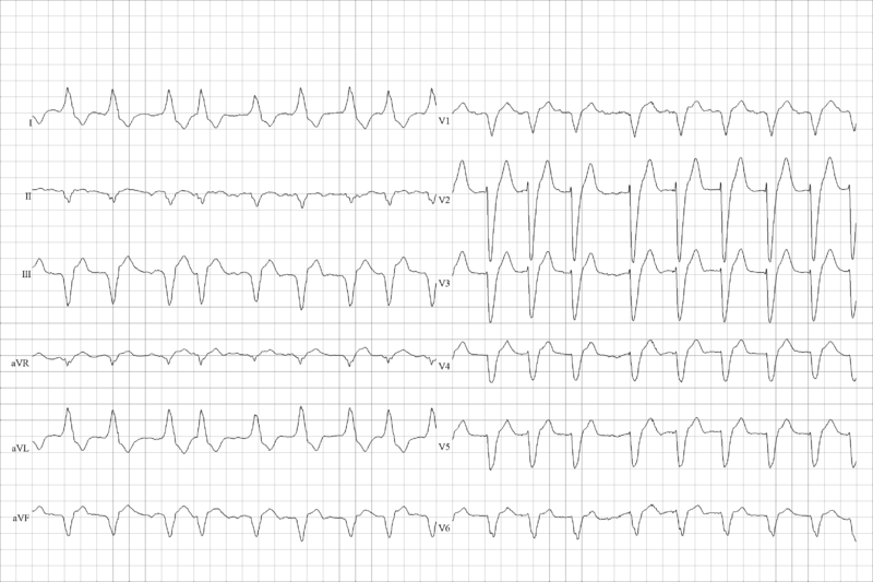 File:LBBB atrial fibrillation.png