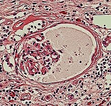 Micrograph of proteinaceous material in Bowman's space, which is unspecific. It is present in about 5% of people aged over 60 years, but also in for example hypertensive kidney disease. Micrograph of proteinaceous material in Bowman's space.jpg