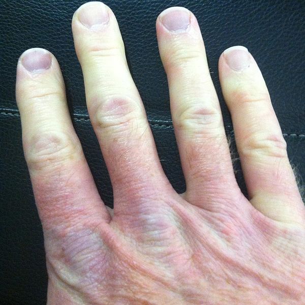 File:Multicolor Raynaud's Right Hand.jpg