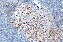 Micrograph highlighting the sustentacular cells in a paraganglioma. S100 immunostain Paraganglioma - s100 - high mag.jpg