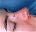 Fotografia A. Rinoplastica aperta: Pre-operative, the guidelines (purple) ensured the surgeon’s accurate incisions in cutting the nasal defect correction plan.