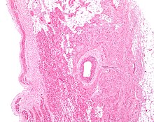 Figure 2: Low magnification stained image of the SA node (center-right on image) and its surrounding tissue. The SA node surrounds the sinoatrial nodal artery, seen as the open lumen. Cardiac muscle cells of the right atrium can be seen to the left of the node, and fat tissue to the right. Sinoatrial node 2 low mag.jpg