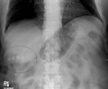 Gallstones as seen on plain X-ray