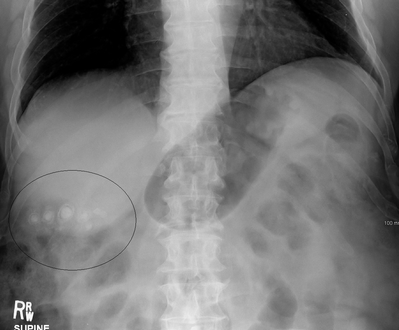 Gallstones as seen on plain X-ray