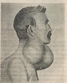 Рак щитовидной железы. Илл. 1914 года