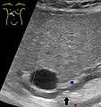 Ultrasonography of common bile duct stone, with arrow.jpg