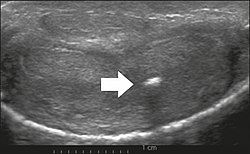 Transverse ultrasound of the penis, in a ventral view, in the middle portion of the penis. Note the echoic image with posterior acoustic shadowing, corresponding to calcification (arrow), in the left corpus cavernosum.[14]