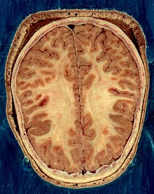 Horizontal section of the head of an adult female human, showing skin, skull, and brain with gray matter (brown in this image) and underlying white matter Visible Human head slice.jpg